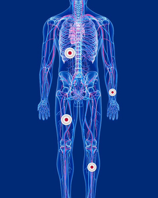 Atherosclerosis