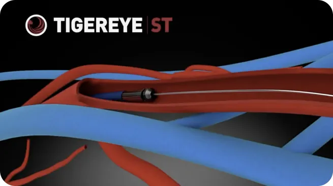 Tigereye ST Explainer Video