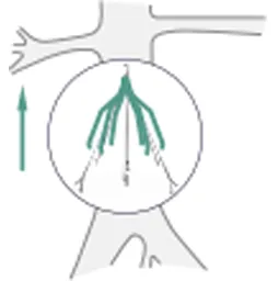 Femoral Vein Access