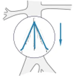Jugular Vein Access