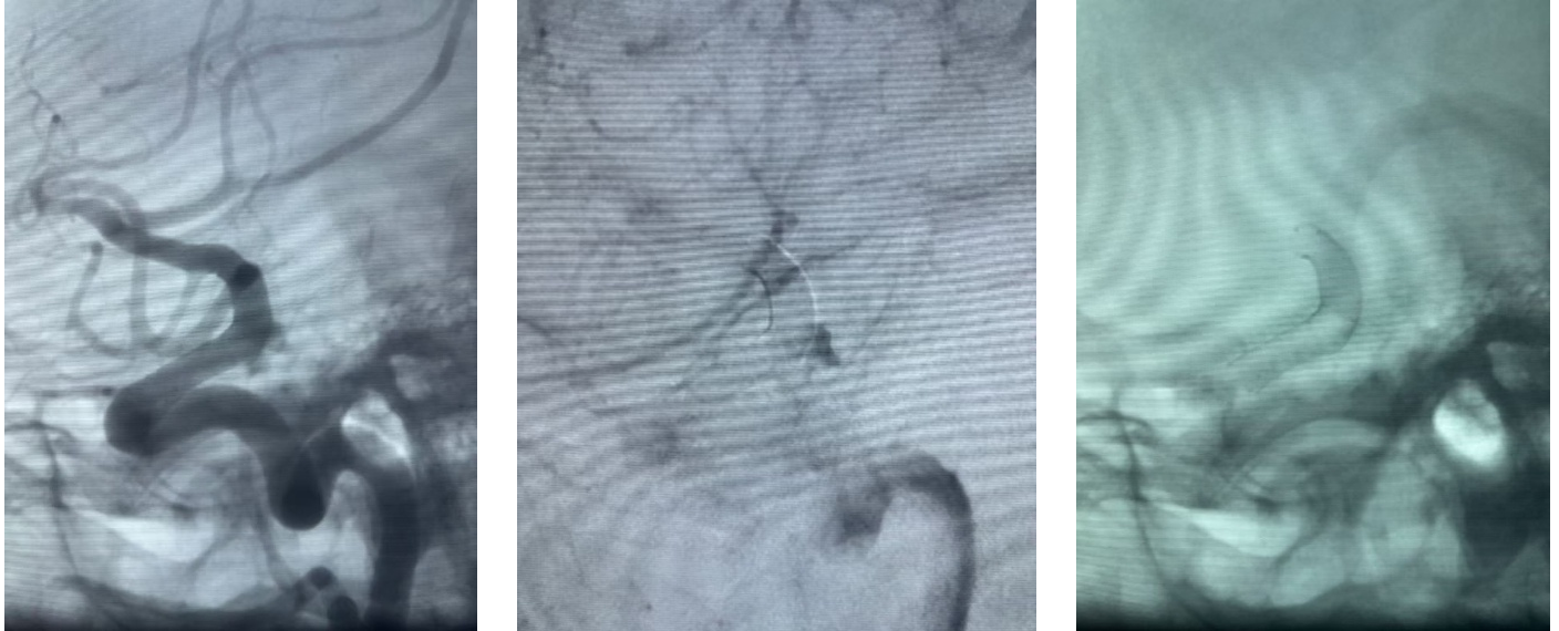 treating-multiple-ica-aneurysms-with-a-single-strategy-kylin-flow-diverter-in-practice.png treating-multiple-ica-aneurysms-with-a-single-strategy-kylin-flow-diverter-in-practice.png