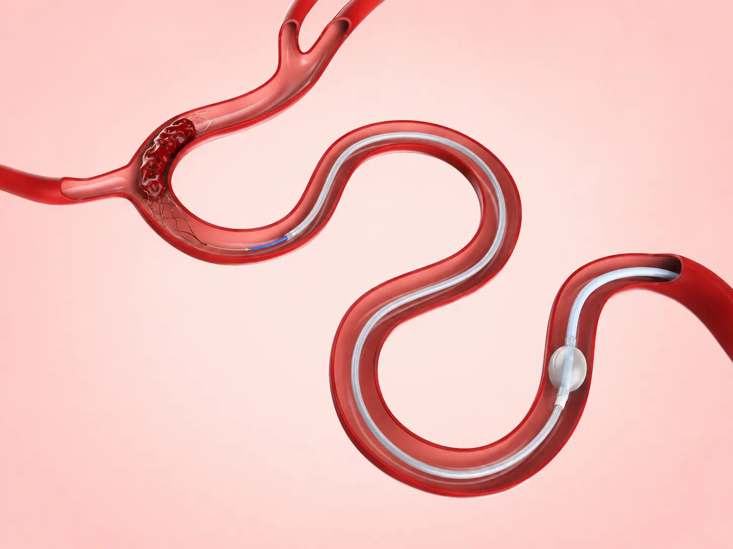 Neurovascular Interventions
