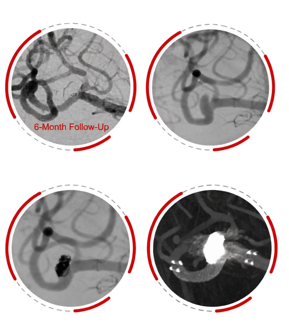 2.5 mm configuration deliverable through a 0.017 inch microcatheter, supporting access to distal vascular lesions