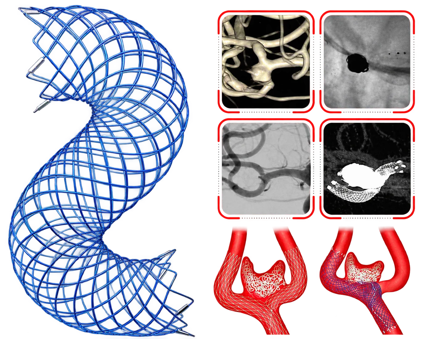 20% metal coverage to provide enhanced scaffolding support for dense coil embolization