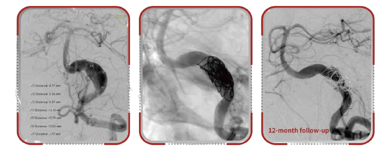 Available in large-diameter configurations(4.5 mm and 5.5 mm)with extended lengths of 50 mm and 75 mm,enabling treatment of long-segment dissecting lesions